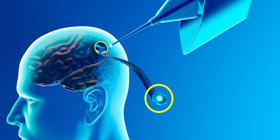 الطفرة التكنولوجية الثالثة: شرائح الأدمغة ورقمنة الانسان